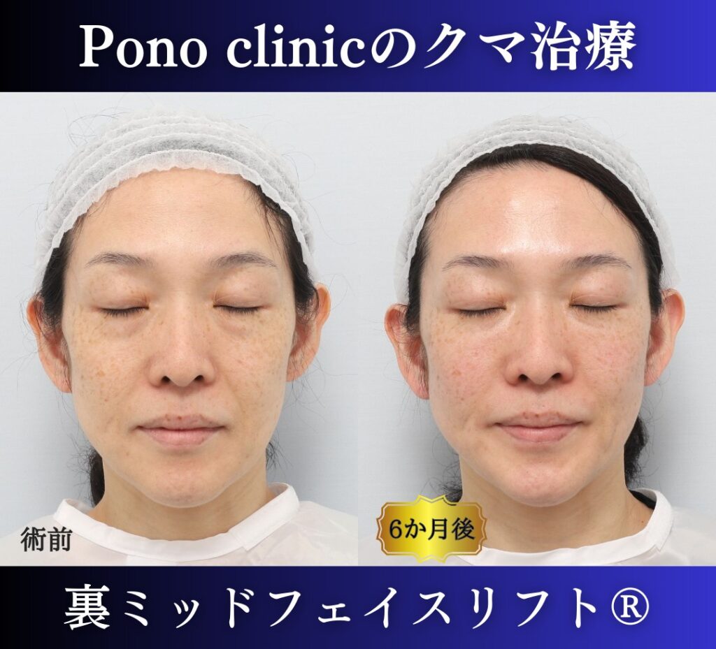 40代女性の症例、目の下のクマ取り (3)