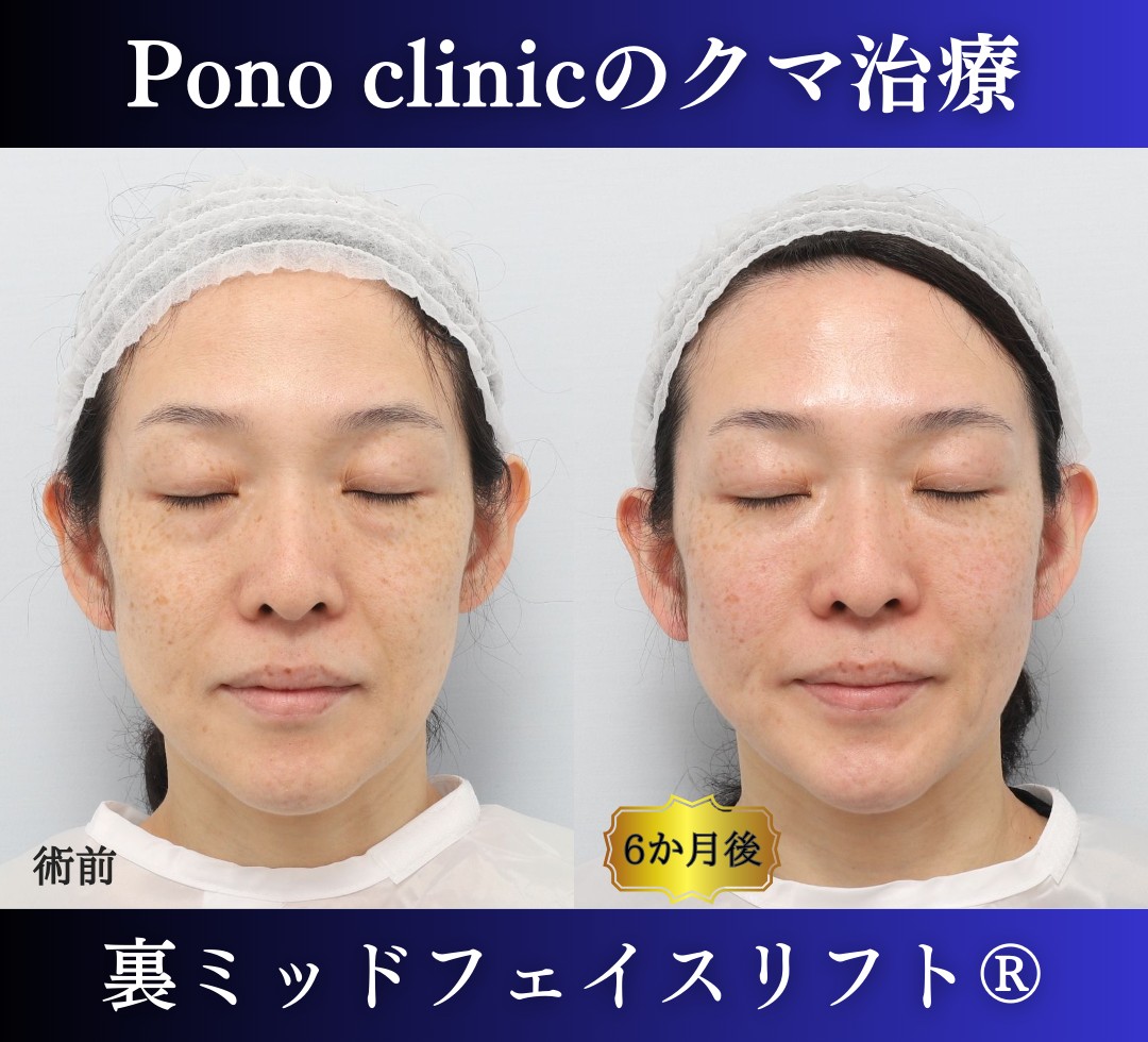 40代女性の症例、目の下のクマ取り (3)