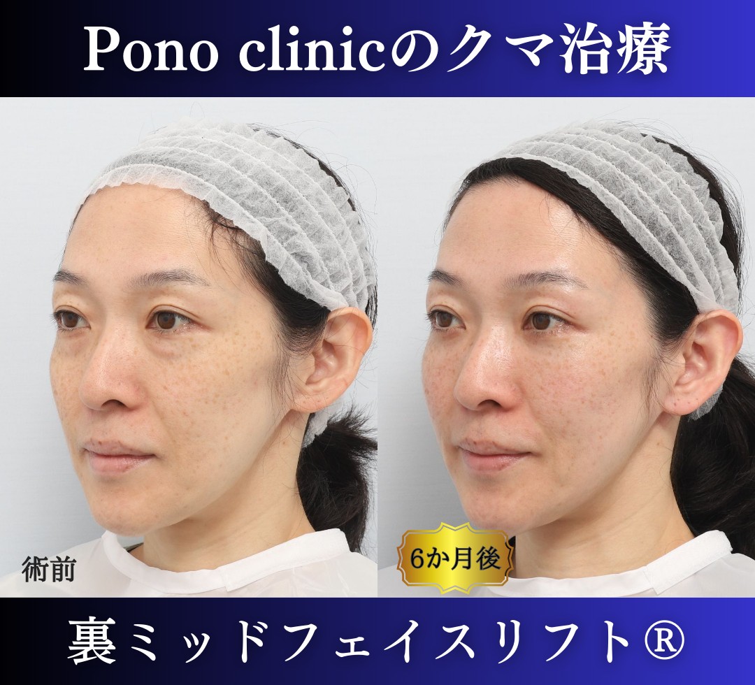 40代女性の症例、目の下のクマ取り (4)