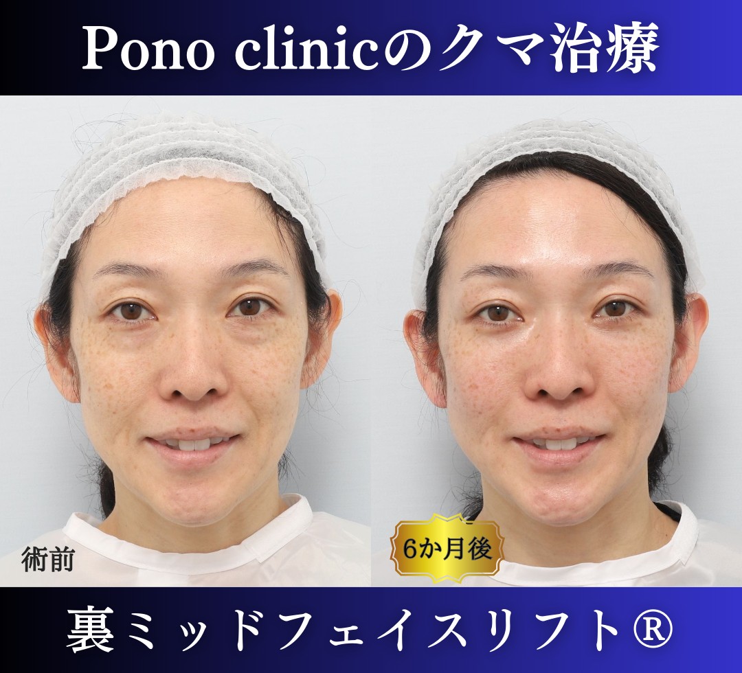 40代女性の症例、目の下のクマ取り (5)