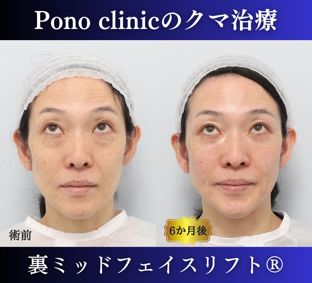 40代女性の症例、目の下のクマ取り (6)