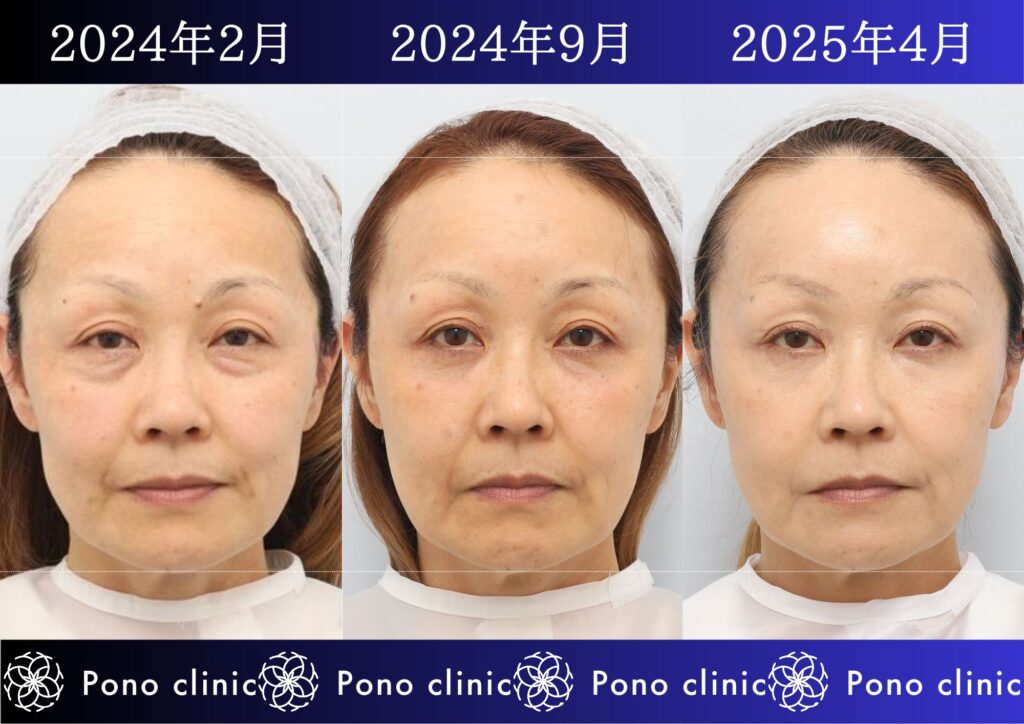 50代女性の症例、目の下のクマ、シワ治療、法令線治療 (1)