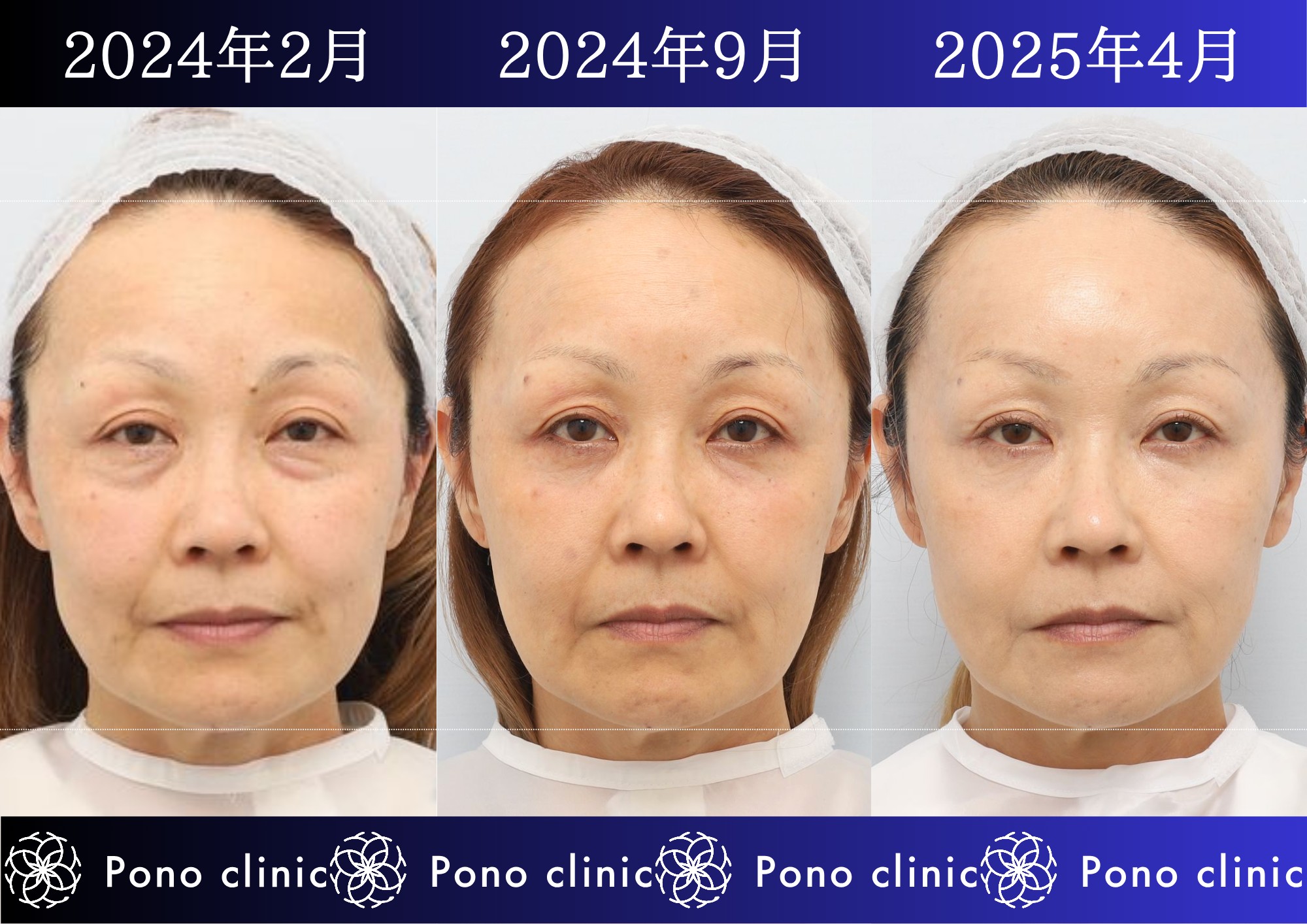 50代女性の症例、目の下のクマ、シワ治療、法令線治療 (1)