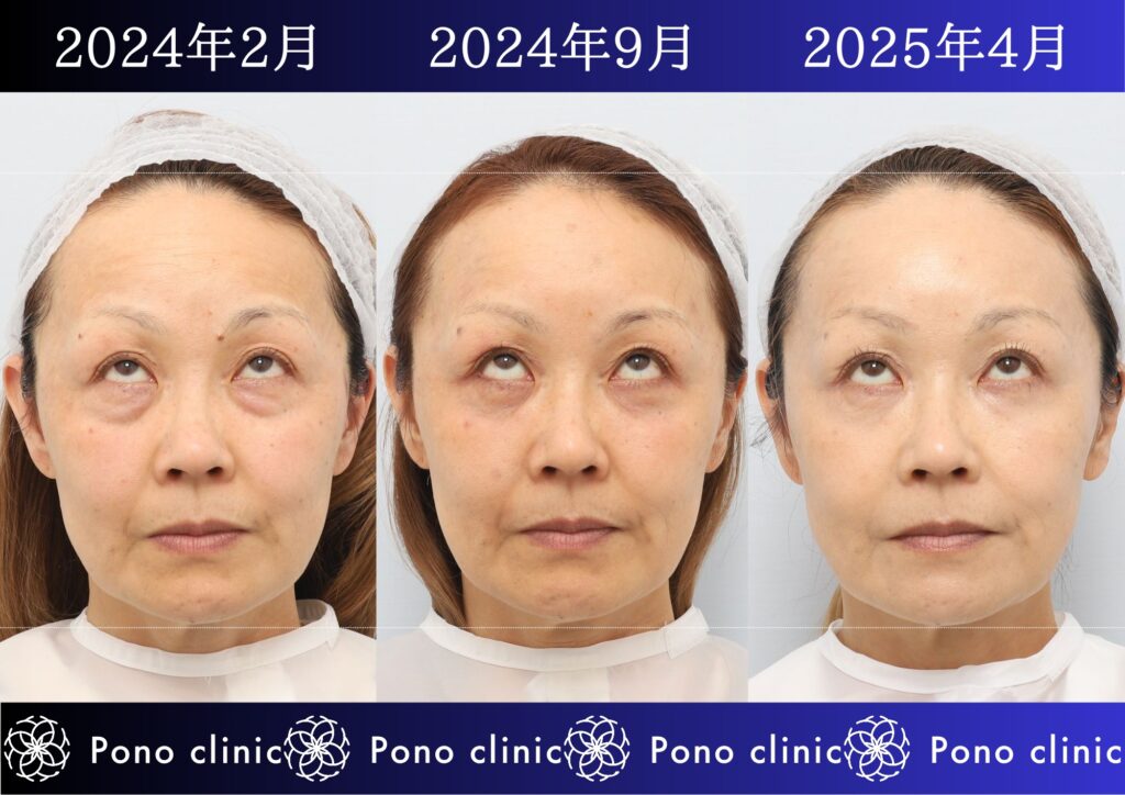 50代女性の症例、目の下のクマ、シワ治療、法令線治療 (2)