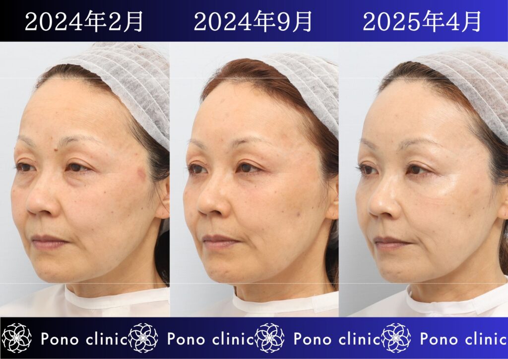 50代女性の症例、目の下のクマ、シワ治療、法令線治療 (3)