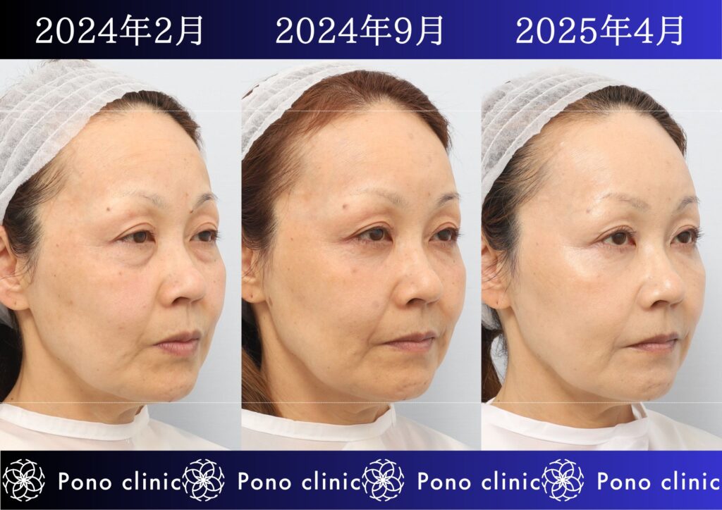 50代女性の症例、目の下のクマ、シワ治療、法令線治療 (4)