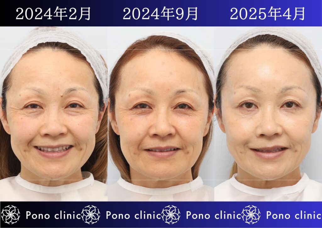 50代女性の症例、目の下のクマ、シワ治療、法令線治療 (5)