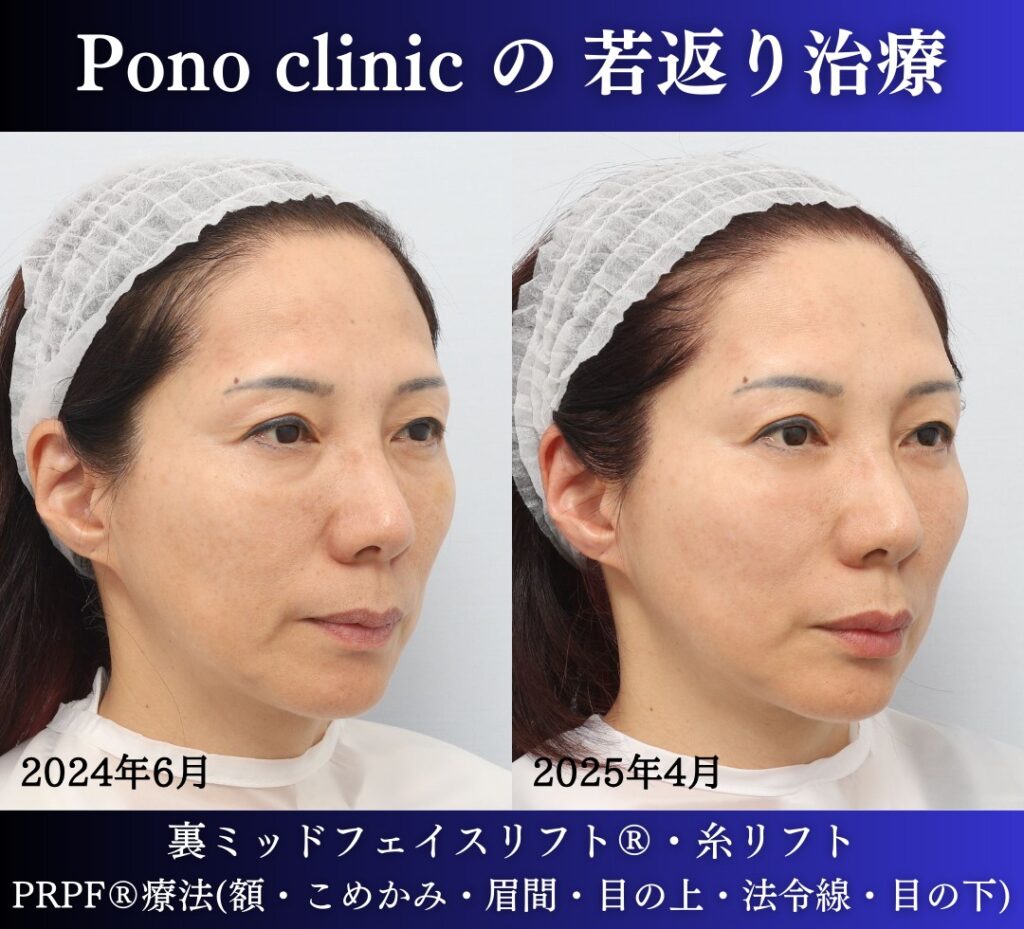 50代女性の症例、目の下のクマ、糸リフト、PRPF療法、若返り治療 (1)