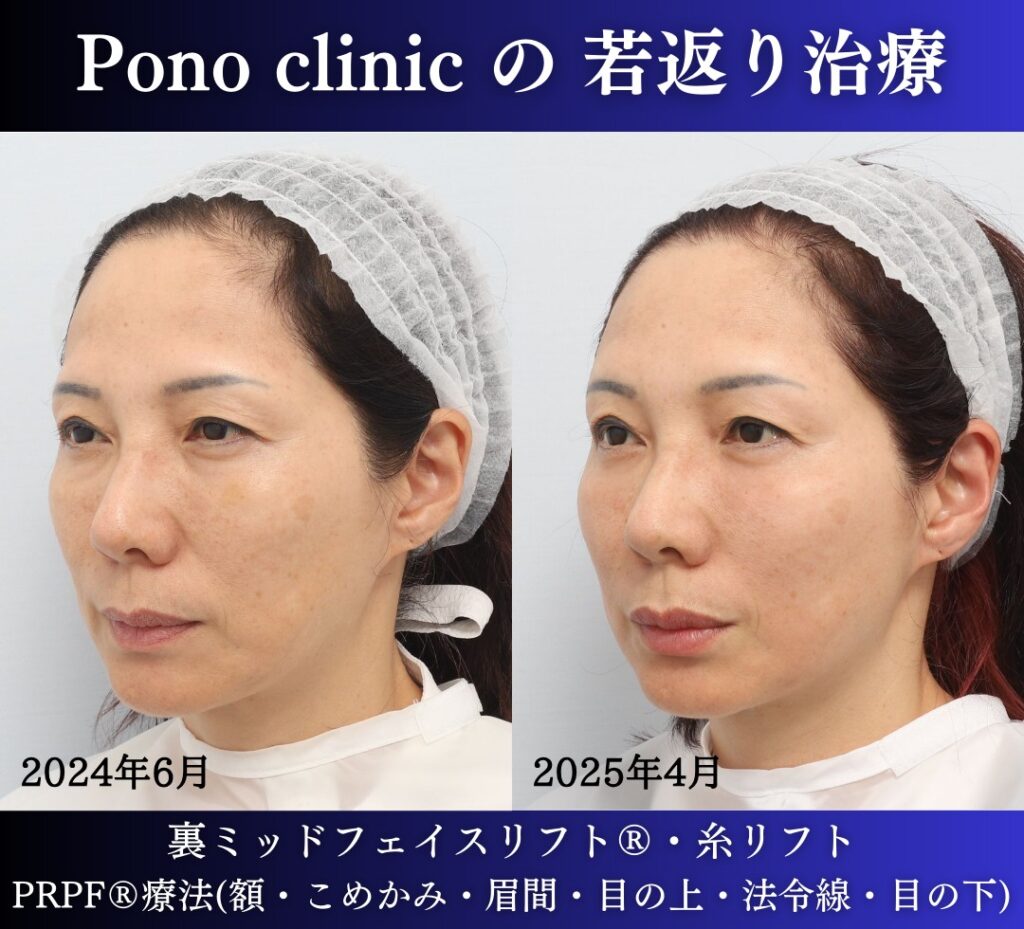 50代女性の症例、目の下のクマ、糸リフト、PRPF療法、若返り治療 (2)