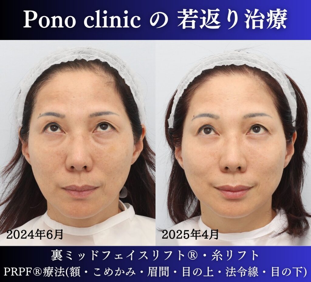 50代女性の症例、目の下のクマ、糸リフト、PRPF療法、若返り治療 (3