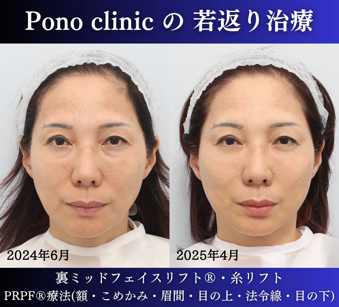 50代女性の症例、目の下のクマ、糸リフト、PRPF療法、若返り治療 (5)