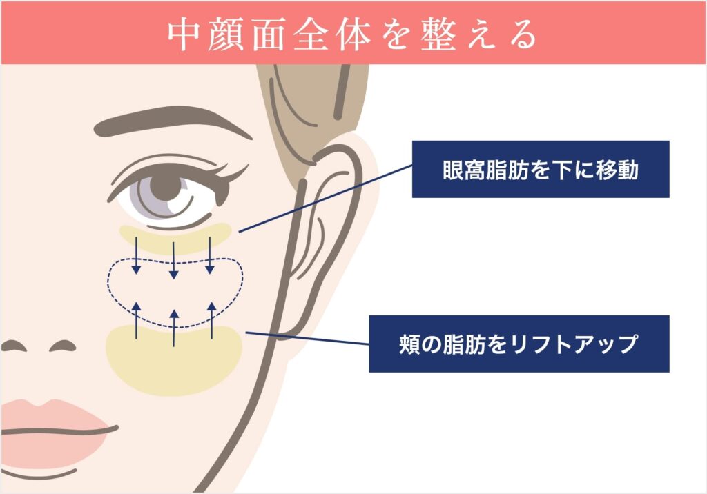 裏ハムラ・裏ミッドフェイスリフト