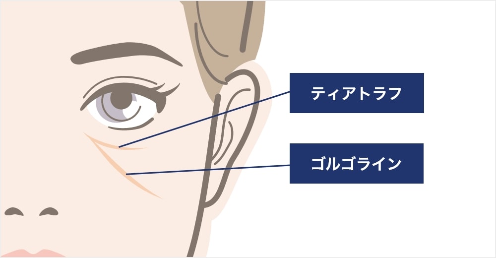 ゴルゴ線ができる原因