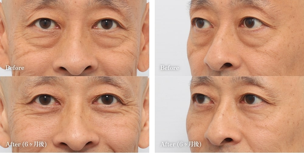 裏ハムラ・裏ミッドフェイスリフト®の症例