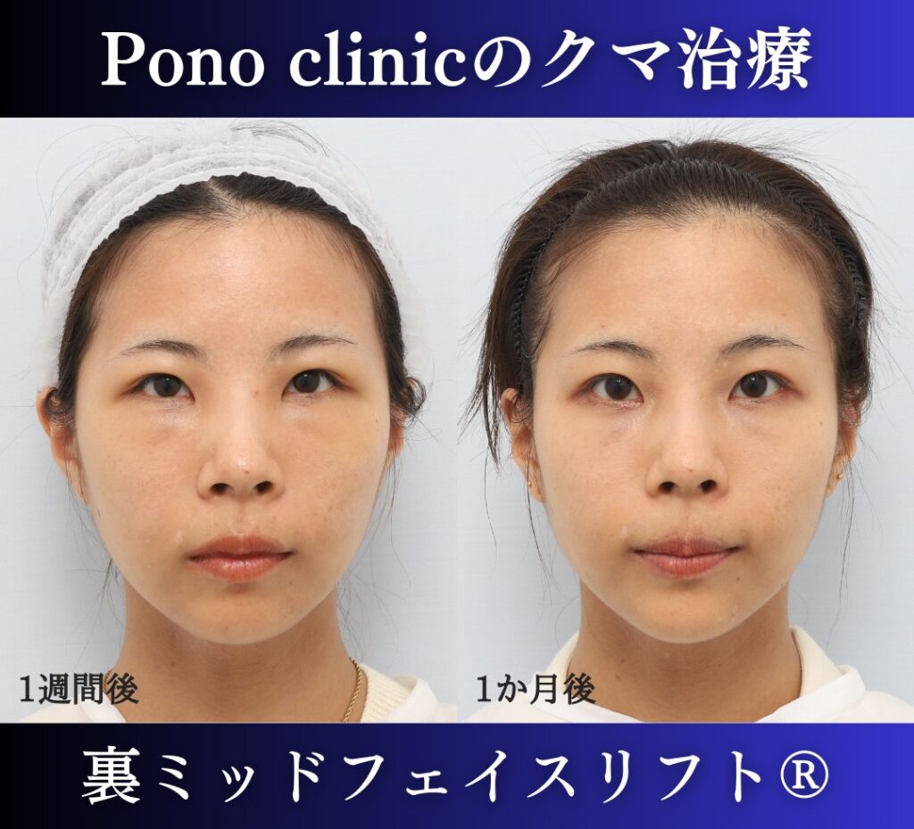 クマ取り手術、裏ミッドフェイスリフト、30代の症例 (1)