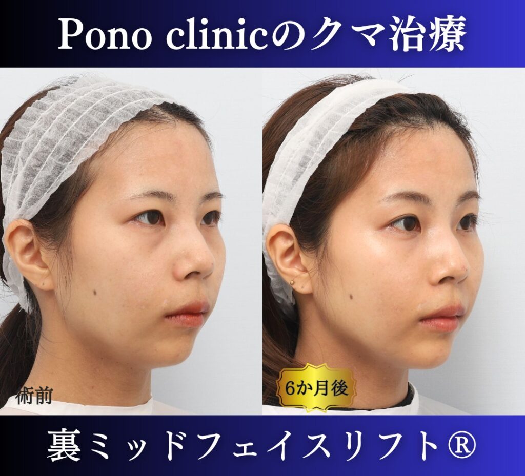 クマ取り手術、裏ミッドフェイスリフト、30代の症例 (2)