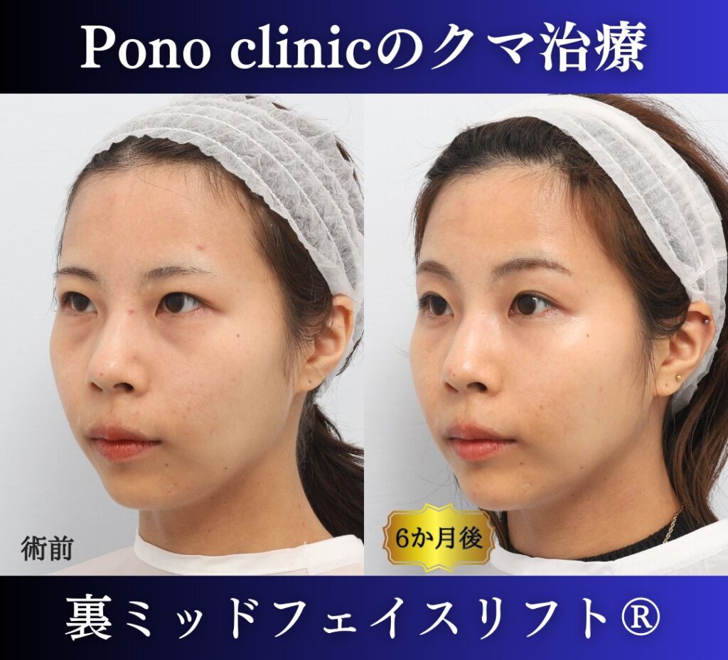 クマ取り手術、裏ミッドフェイスリフト、30代の症例 (3)