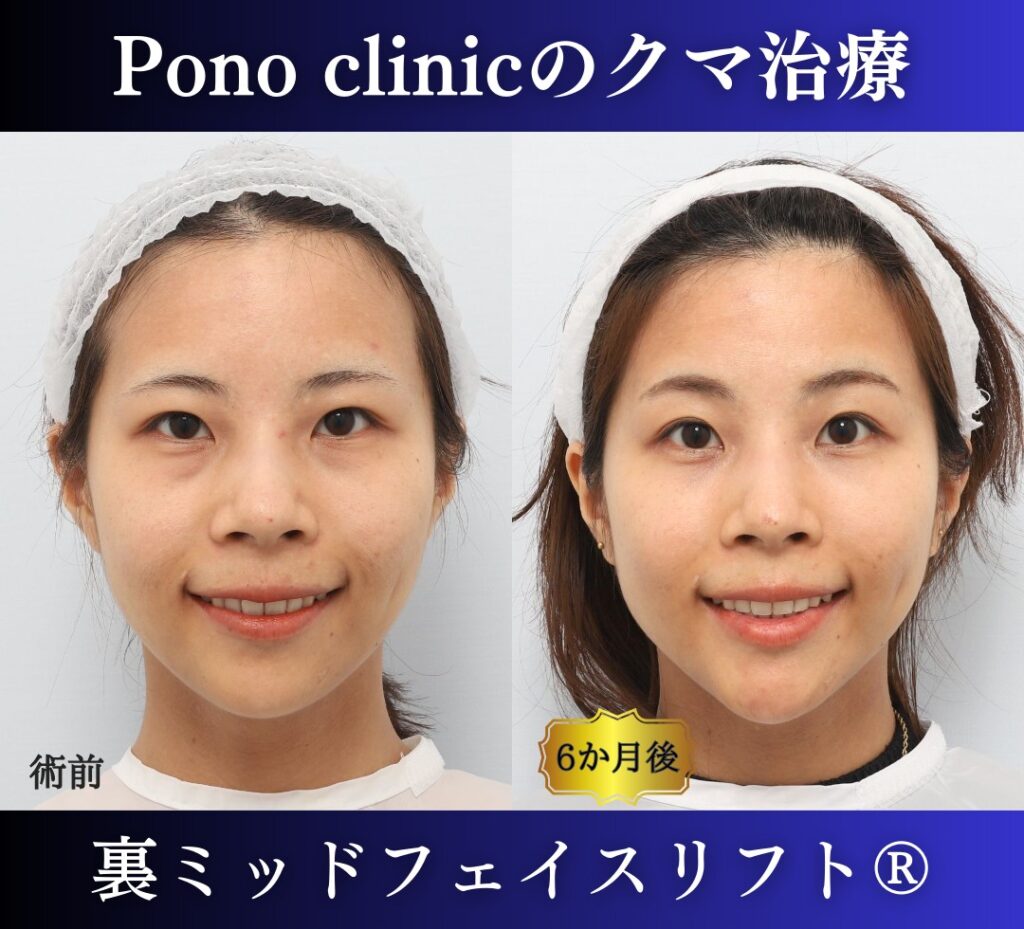 クマ取り手術、裏ミッドフェイスリフト、30代の症例 (4)