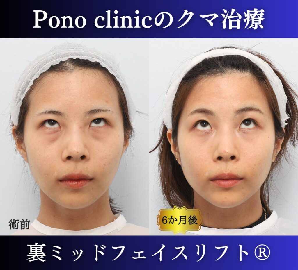 クマ取り手術、裏ミッドフェイスリフト、30代の症例 (5)