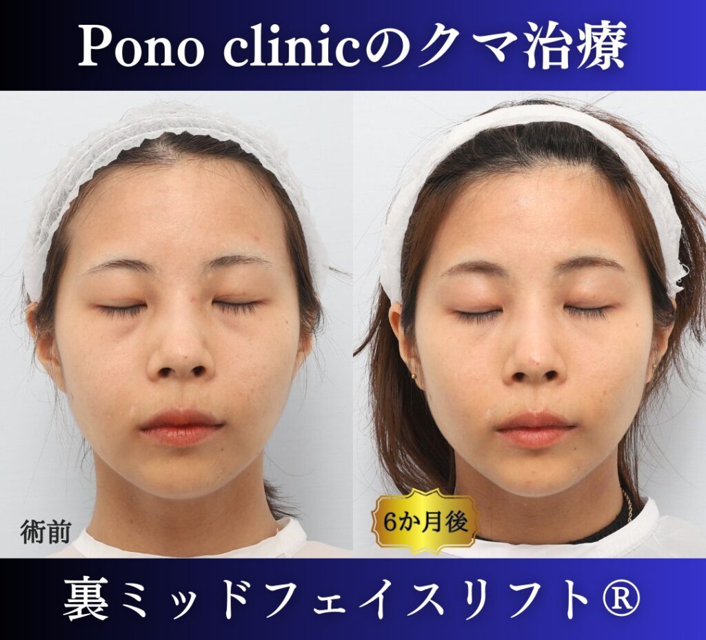 クマ取り手術、裏ミッドフェイスリフト、30代の症例 (6)