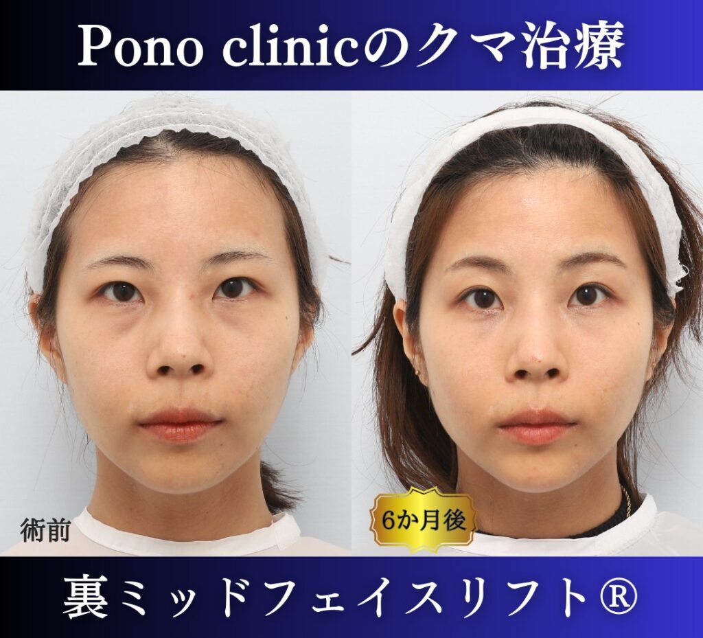 クマ取り手術、裏ミッドフェイスリフト、30代の症例 (7)