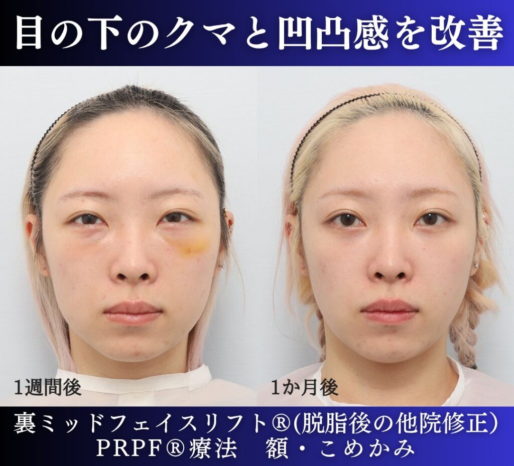 20代女性の症例、脱脂後の修正、裏ハムラ、目の下のクマ取り (1)