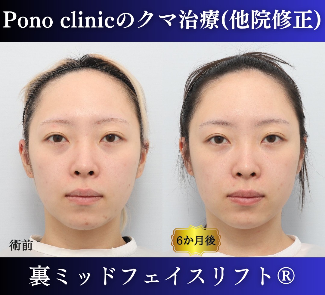 20代女性の症例、脱脂後の修正、裏ハムラ、目の下のクマ取り (10)