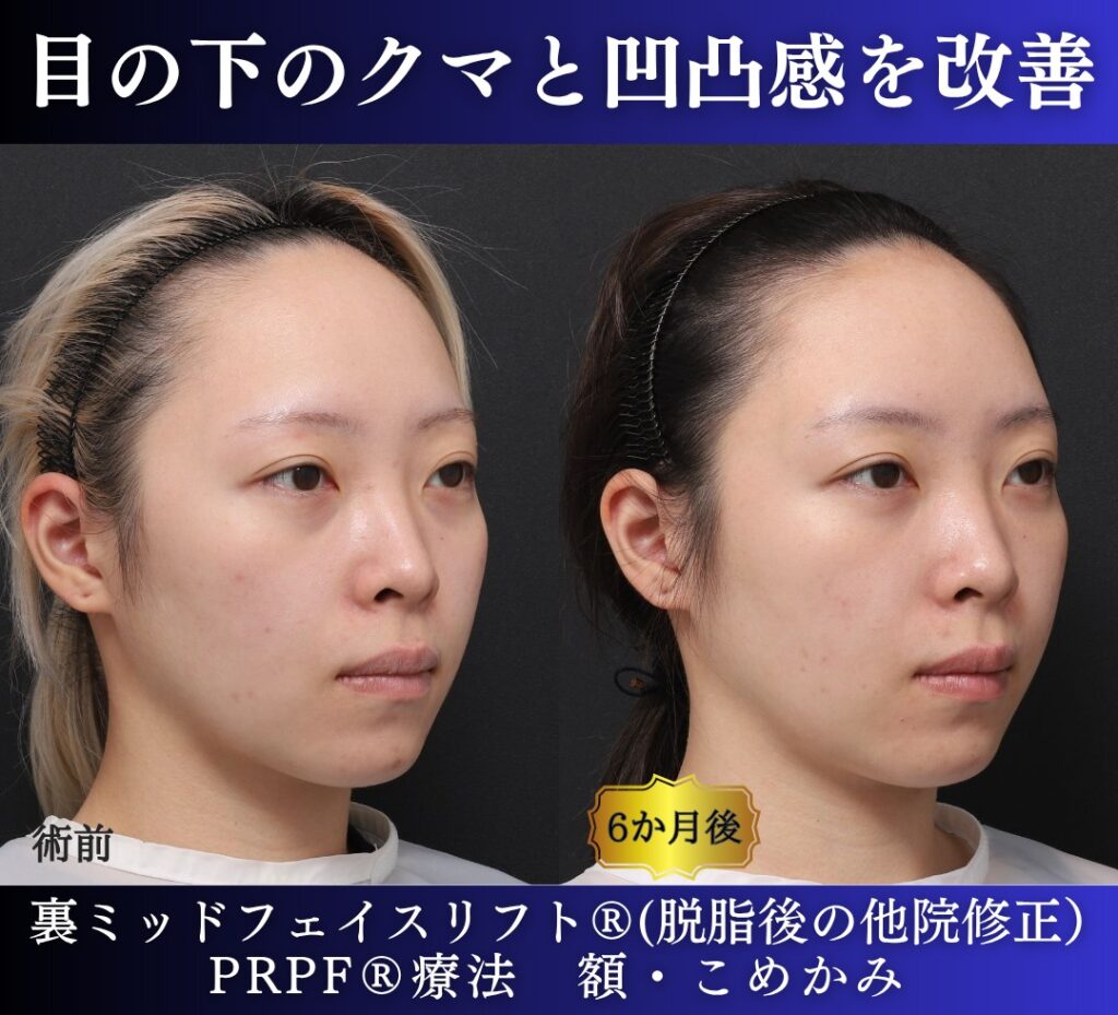 20代女性の症例、脱脂後の修正、裏ハムラ、目の下のクマ取り (2)