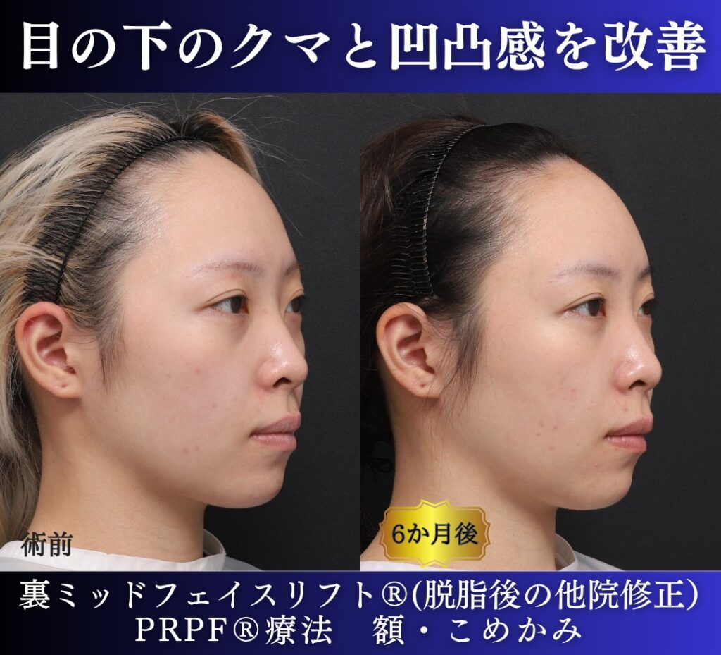 20代女性の症例、脱脂後の修正、裏ハムラ、目の下のクマ取り (3)