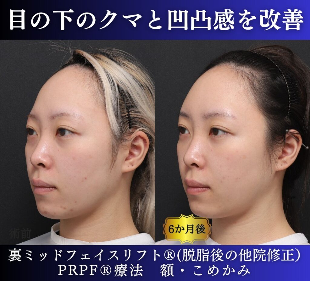 20代女性の症例、脱脂後の修正、裏ハムラ、目の下のクマ取り (4)