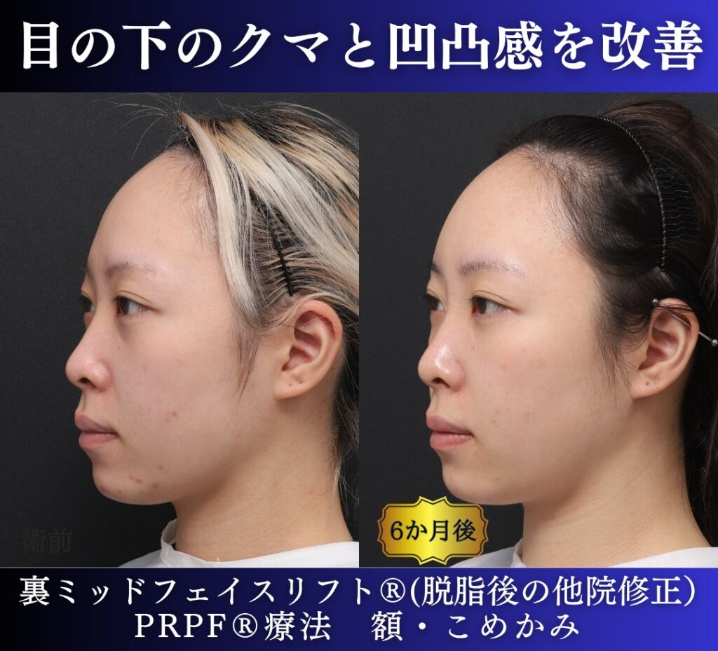 20代女性の症例、脱脂後の修正、裏ハムラ、目の下のクマ取り (5)