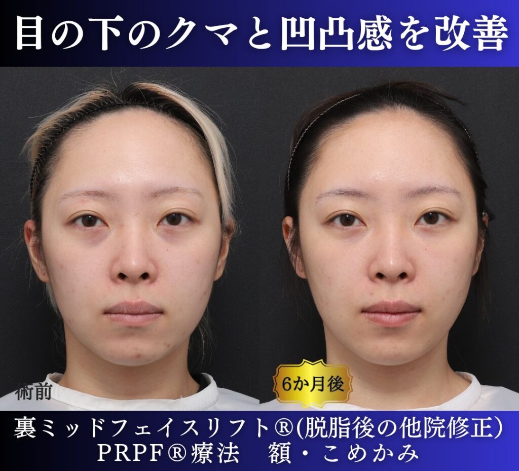 20代女性の症例、脱脂後の修正、裏ハムラ、目の下のクマ取り (6)