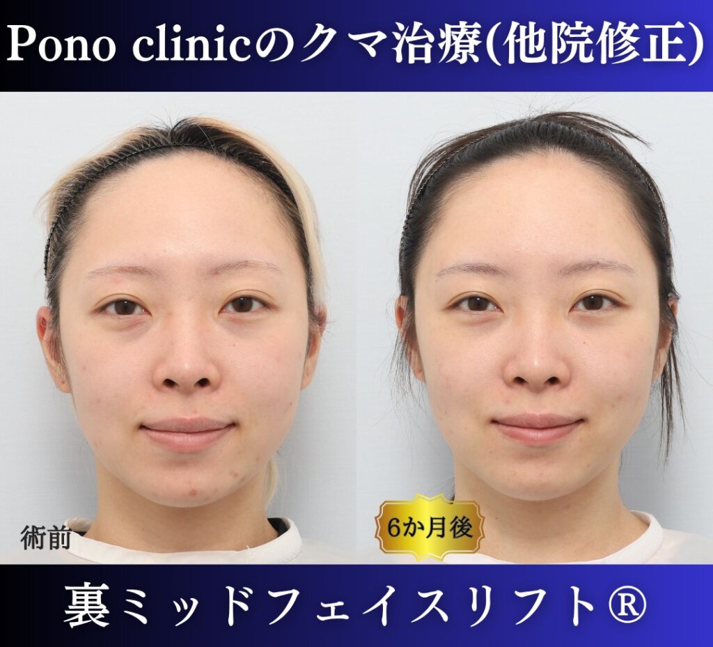 20代女性の症例、脱脂後の修正、裏ハムラ、目の下のクマ取り (7)