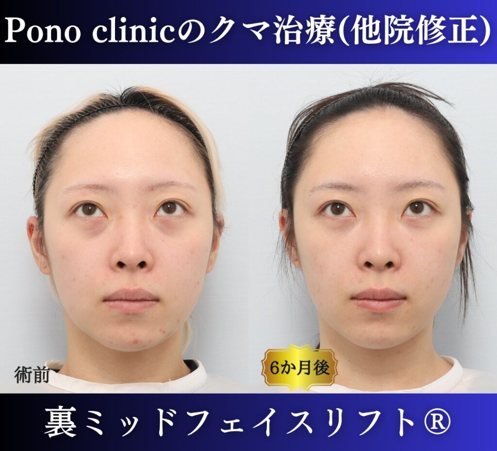 20代女性の症例、脱脂後の修正、裏ハムラ、目の下のクマ取り (8)