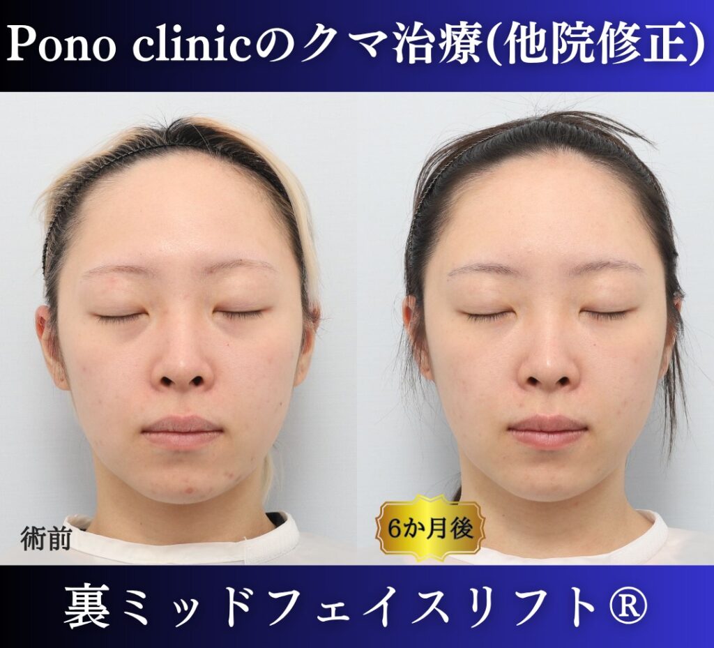 20代女性の症例、脱脂後の修正、裏ハムラ、目の下のクマ取り (9)