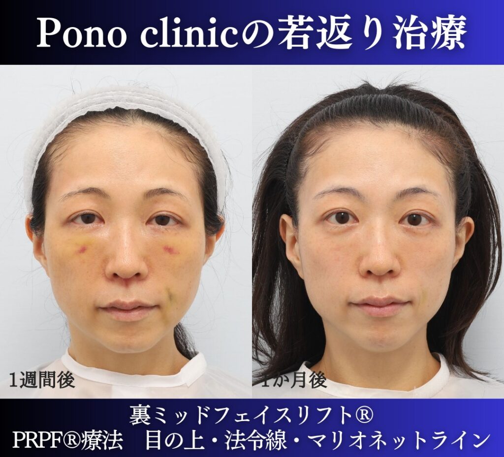 30代の症例、若返り治療PRP注射、目の下のクマ取り、裏ハムラ法 (1)