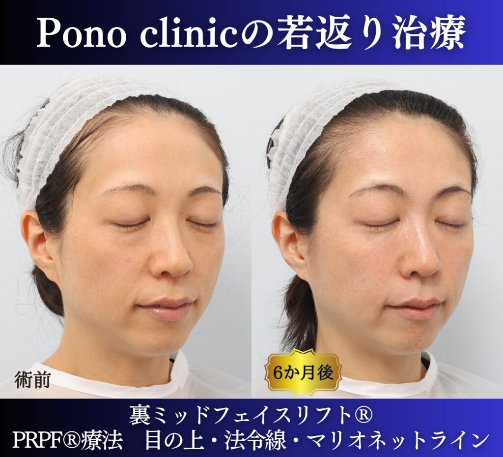 30代の症例、若返り治療PRP注射、目の下のクマ取り、裏ハムラ法 (2)