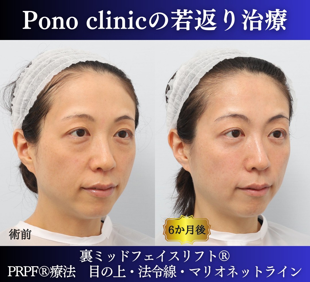 30代の症例、若返り治療PRP注射、目の下のクマ取り、裏ハムラ法 (3)