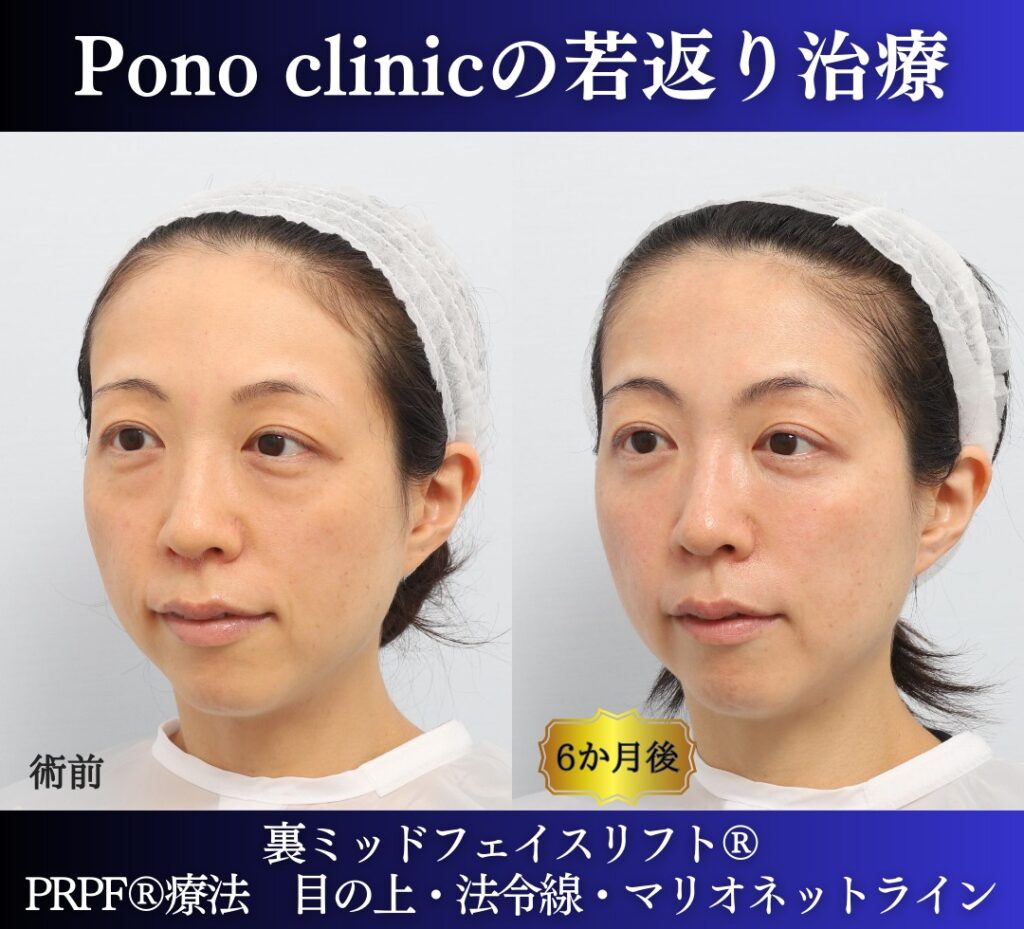 30代の症例、若返り治療PRP注射、目の下のクマ取り、裏ハムラ法 (4)