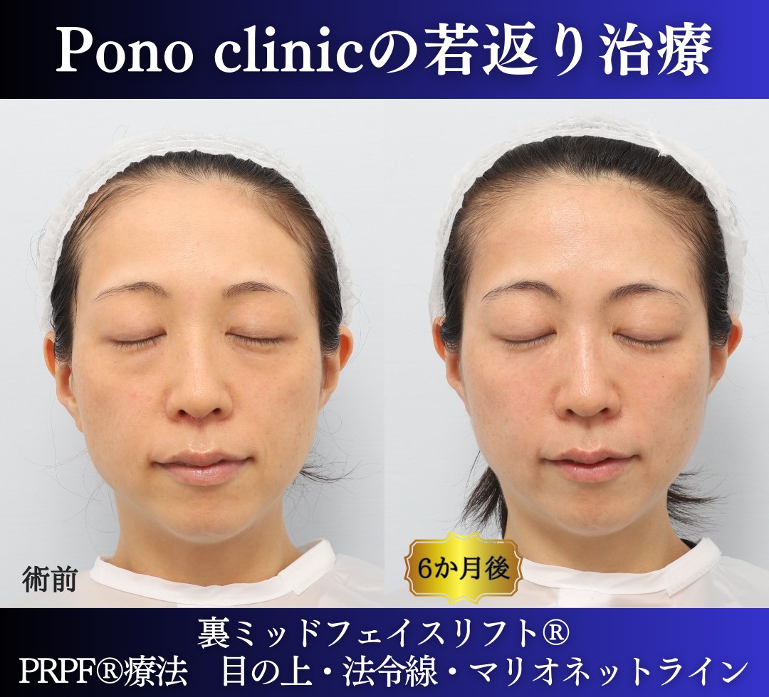 30代の症例、若返り治療PRP注射、目の下のクマ取り、裏ハムラ法 (5)