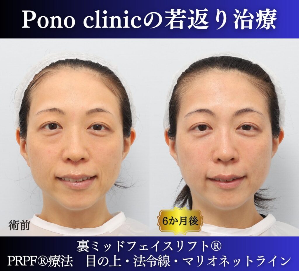 30代の症例、若返り治療PRP注射、目の下のクマ取り、裏ハムラ法 (7)