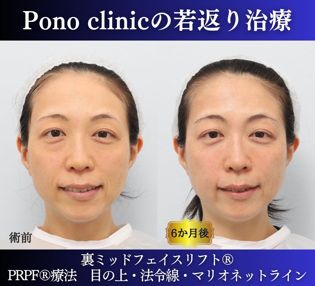 30代の症例、若返り治療PRP注射、目の下のクマ取り、裏ハムラ法 (7)