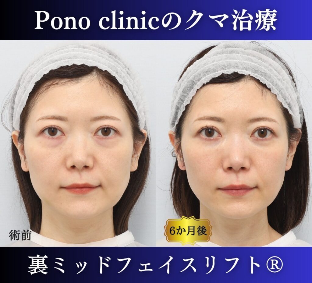 30代女性の症例、目の下のたるみ取り、目の下のクマ取り (6)