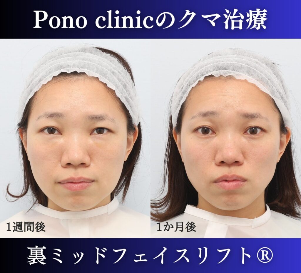 30代女性の症例、目の下のクマ取り、裏ハムラ (1)