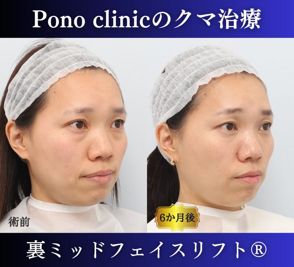 30代女性の症例、目の下のクマ取り、裏ハムラ (2)