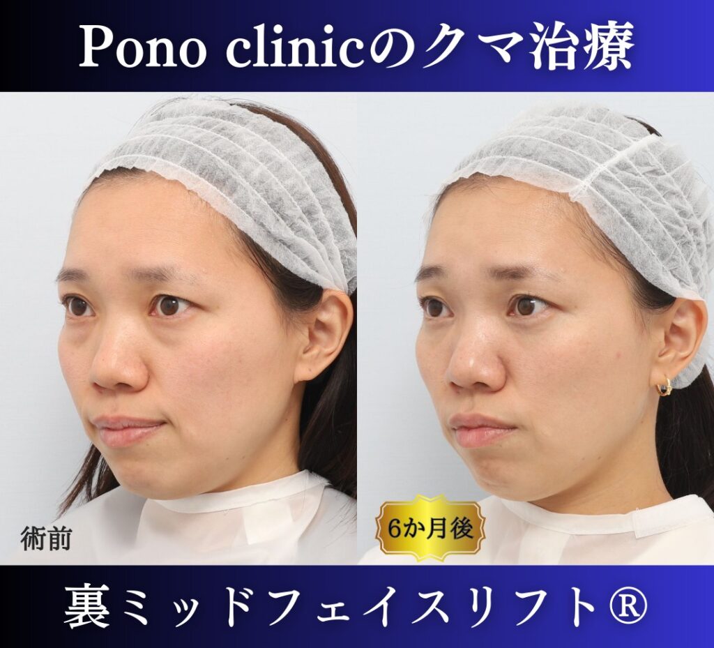 30代女性の症例、目の下のクマ取り、裏ハムラ (3)