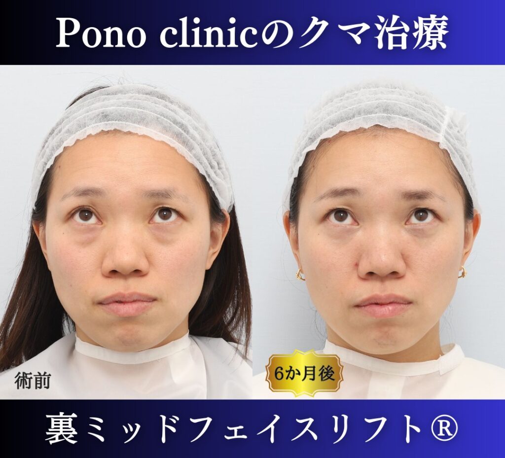 30代女性の症例、目の下のクマ取り、裏ハムラ (4)