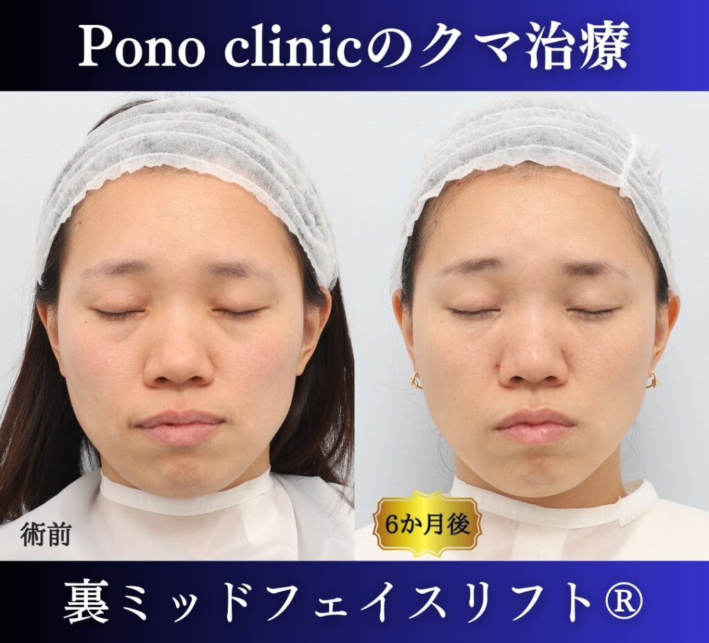 30代女性の症例、目の下のクマ取り、裏ハムラ (5)