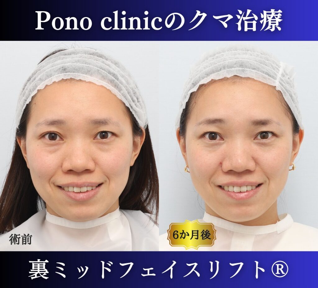 30代女性の症例、目の下のクマ取り、裏ハムラ (6)