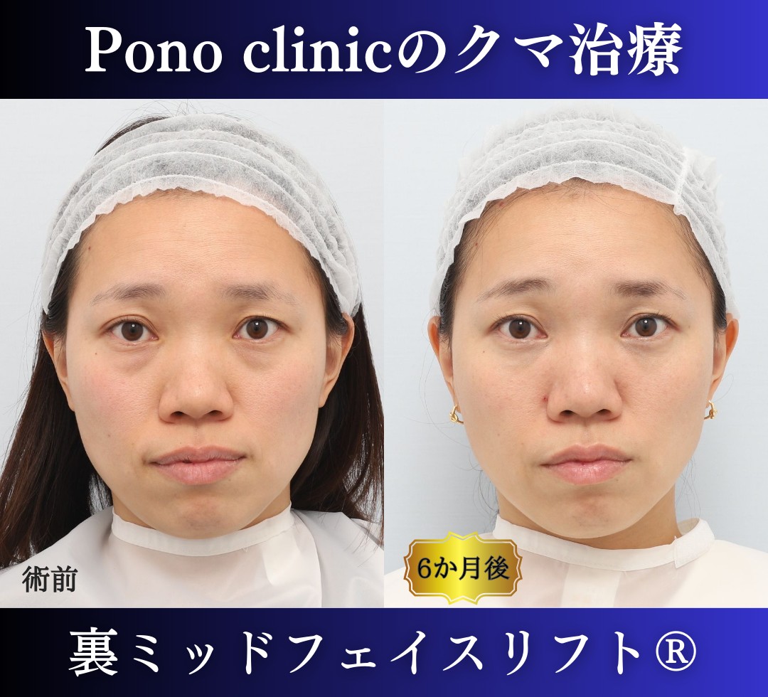 30代女性の症例、目の下のクマ取り、裏ハムラ (7)